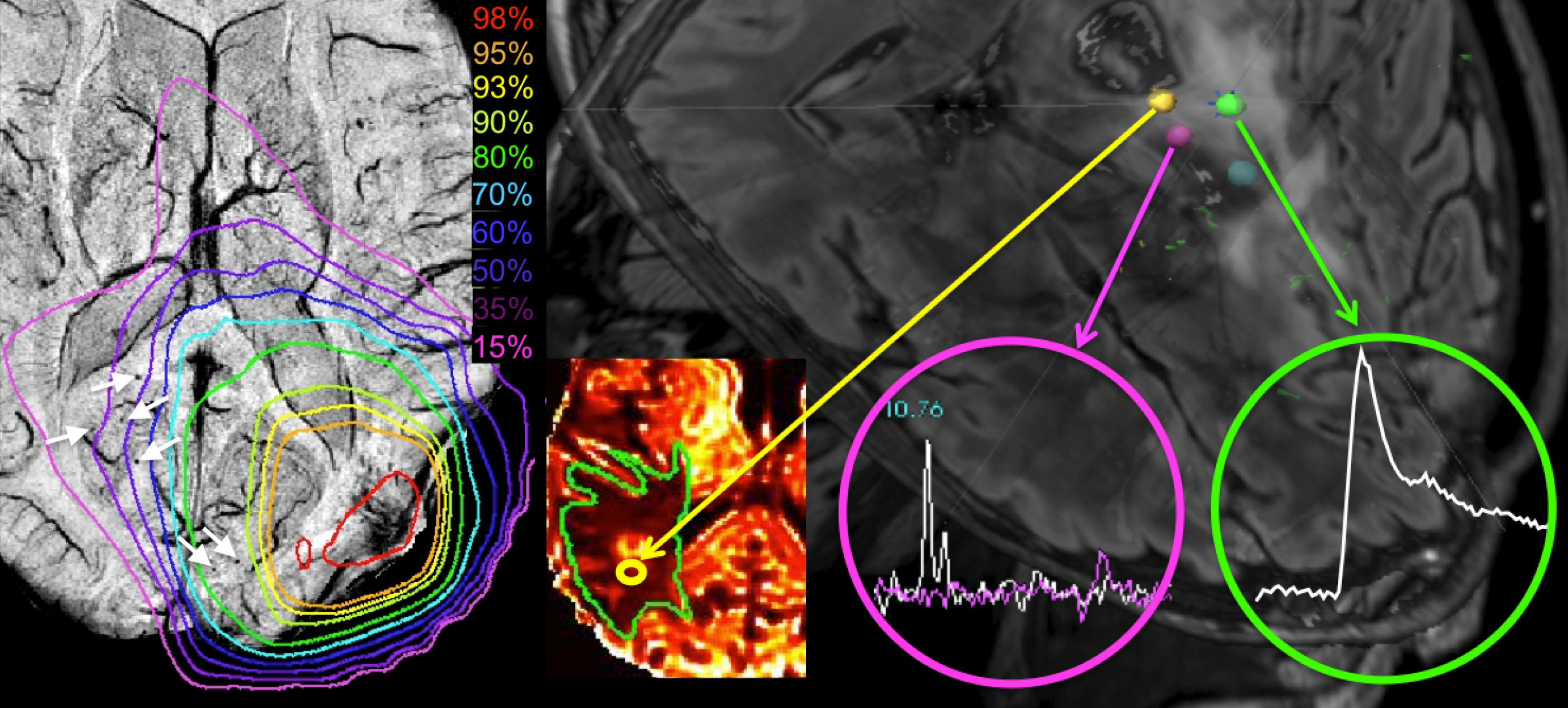 MRI composite image showing the effects of radiation therapy on brain vasculature and mapping of image-guided tissue samples.