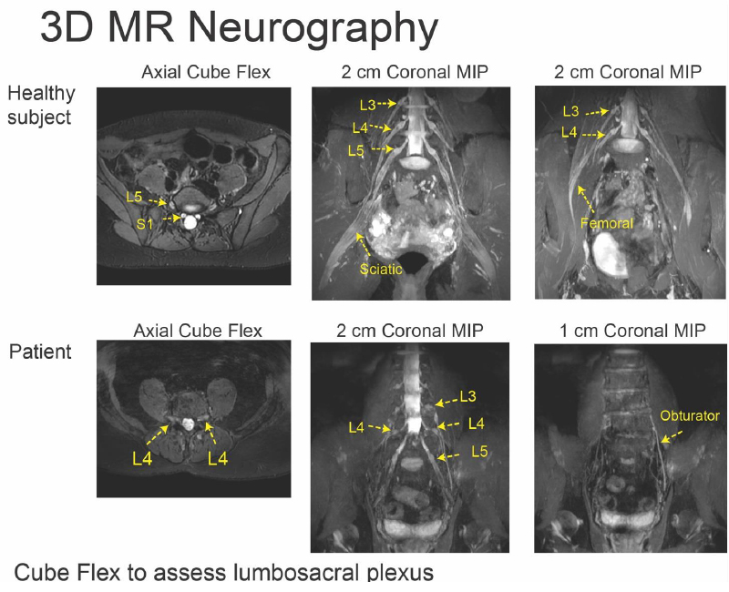3d-MR-Neurography.jpg