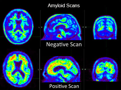 Amyloid Scans