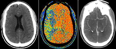 CT-brain-stroke2.png