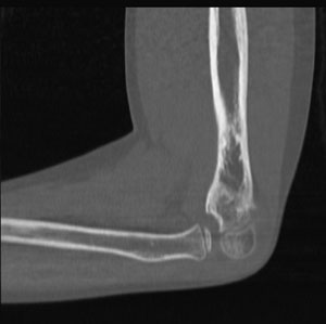 Elbow-CT.jpg