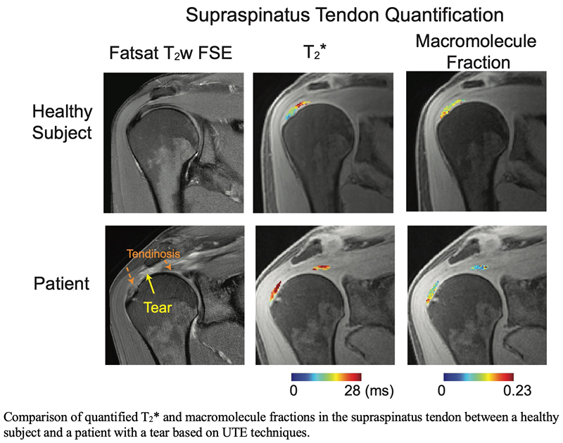MRI-Rotator-Cuff-Tendon-Degeneration.jpg
