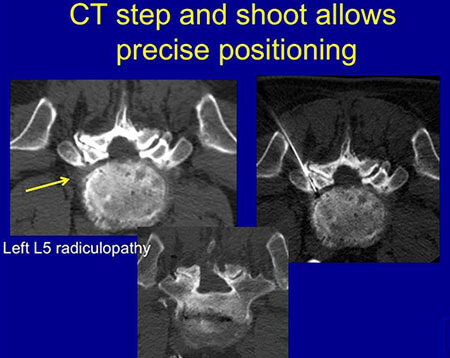 arthrogram-ct