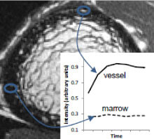 High resolution bone image showing cortical porosity with overlaid graph illustrating differences in signal intensity over time between blood vessels and marrow within cortical pores.