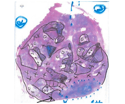 Histopathology slide demonstrating cancerous and benign tissues. Figure 1.