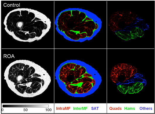 This study uses advanced MRI to examine how abnormal meniscus motion contributes to cartilage damage and the progression of knee osteoarthritis.