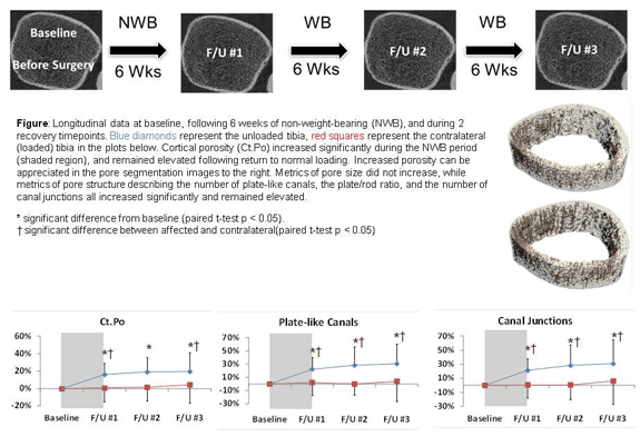 Longitudinal HR pQCT images showing cortical bone before surgery, after non weight bearing, and during recovery, with increasing cortical porosity over time and graphs showing changes in porosity, plate like canals, and canal junctions.