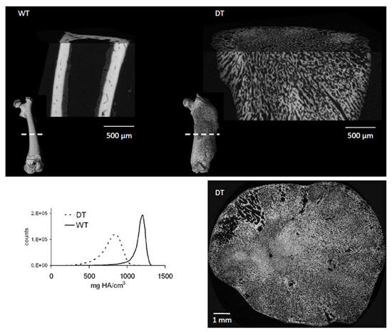 Micro CT images comparing wild type and disease model bone, showing differences in cortical and trabecular structure, cross sectional views, and a graph of bone mineral density distribution highlighting altered mineralization.