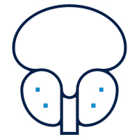 picture of prostate cancer