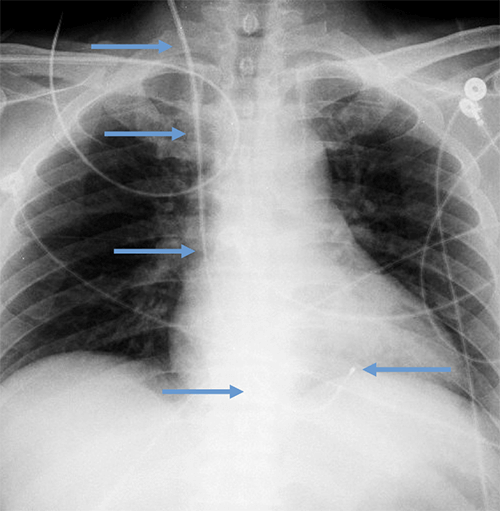 Temporary transvenous lead