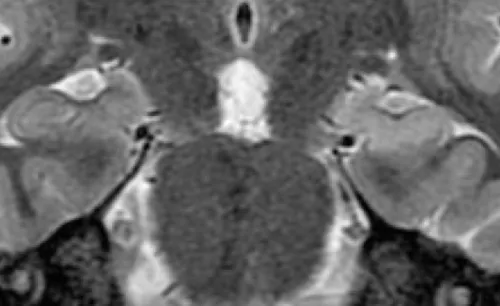 MRI examination of the brain, close-up image showing left hippocampal sclerosis.