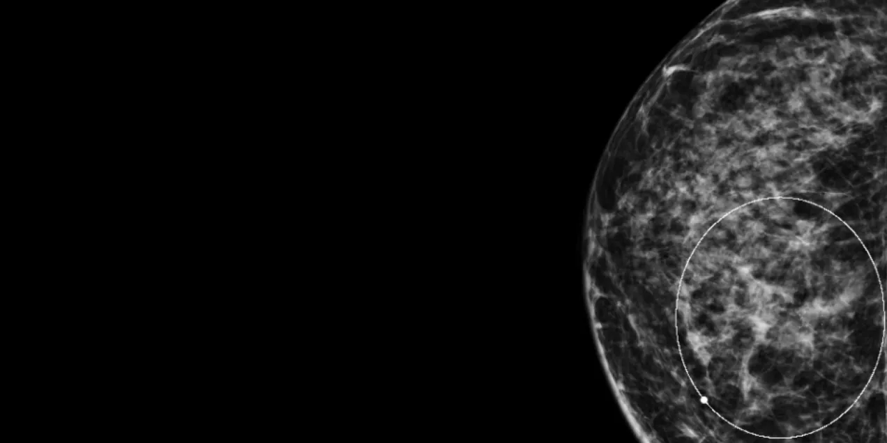 Mammogram image of the right breast showing dense breast tissue with a circular marking highlighting an area of interest.