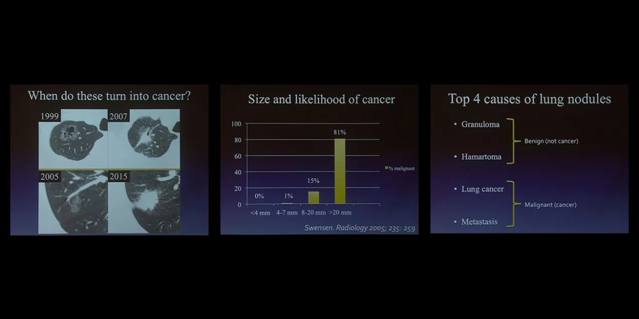 Three-panel slide showing lung nodule progression over years, a bar chart linking nodule size to cancer risk, and a list of the top causes of lung nodules classified as benign or malignant.