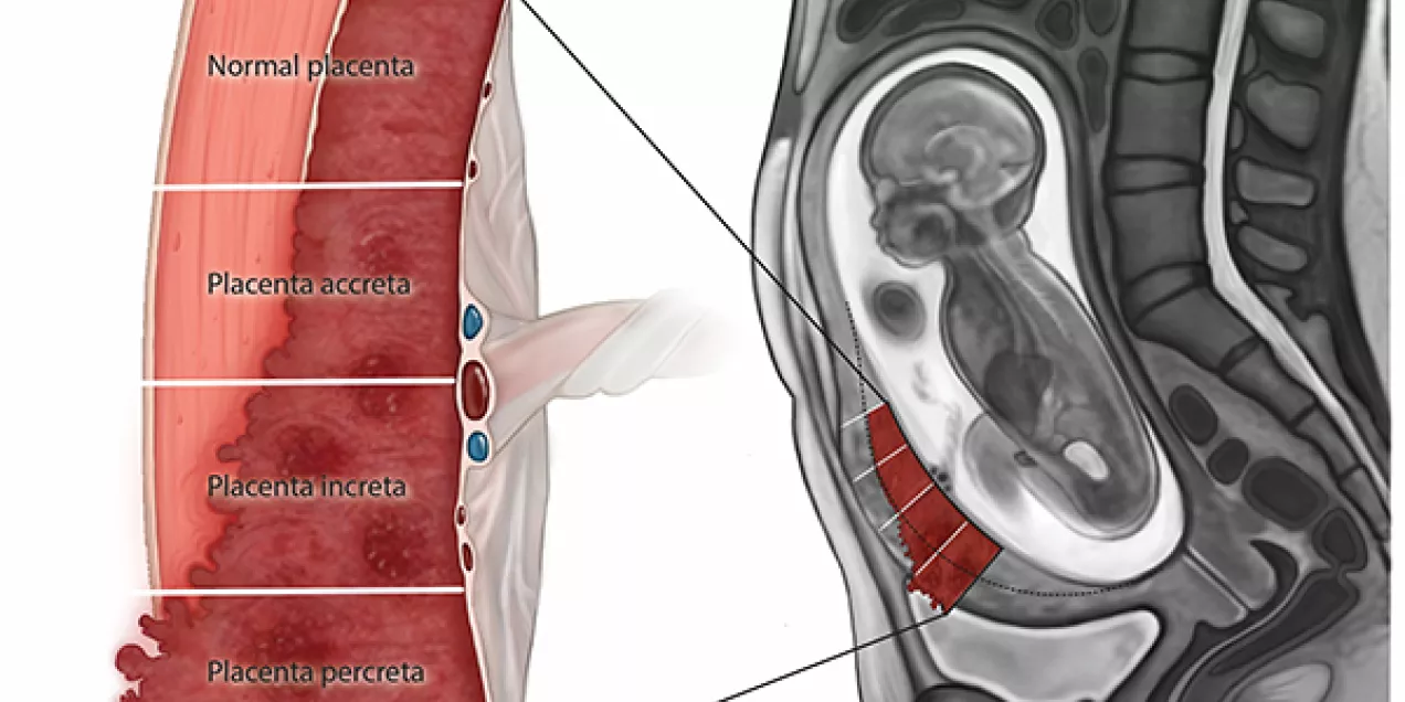 MAPS article PASD illustration TIFF figure 1 (For Blog).jpg