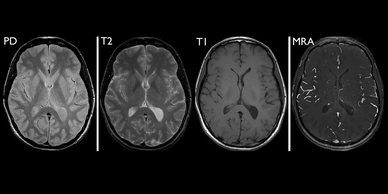 four axial brain images side by side showing PD, T2, T1, and MRA MRI sequences for comparison