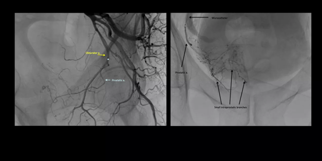 side-by-side fluoroscopic images of the pelvic arteries during prostate artery embolization; the left panel shows contrast outlining the obturator artery and prostatic artery, and the right panel shows a microcatheter positioned with contrast filling small intraprostatic arterial branches
