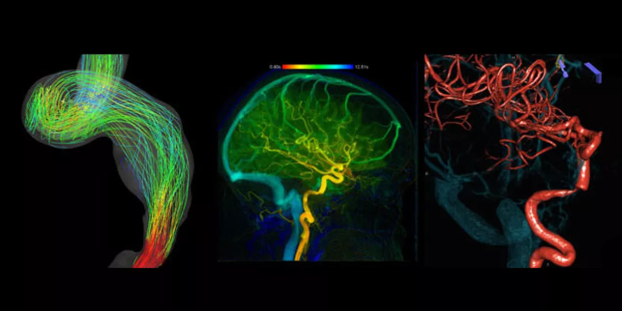 three medical imaging visuals showing colorful neural pathways and blood vessels, including a curved bundle of nerve fibers, a glowing side view of the brain with highlighted vessels, and a 3D rendering of red vascular structures