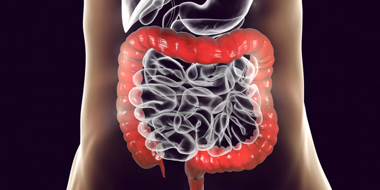 3-D digital rendering of the large intestine in red and transparent gray, overlaid on a patient’s torso, illustrating a non-invasive CT colonography screening.