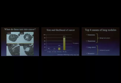Three-panel slide showing lung nodule progression over years, a bar chart linking nodule size to cancer risk, and a list of the top causes of lung nodules classified as benign or malignant.