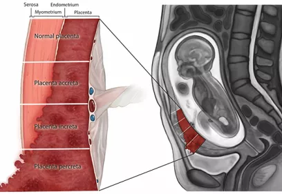 MAPS article PASD illustration TIFF figure 1 (For Blog).jpg