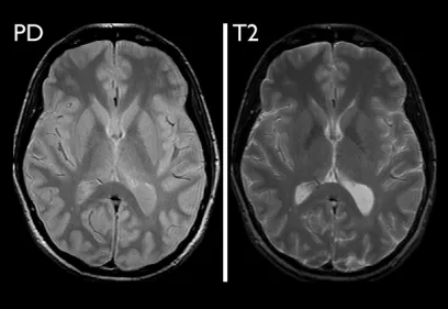 axial brain images side by side showing PD, T2, T1, and MRA MRI sequences for comparison