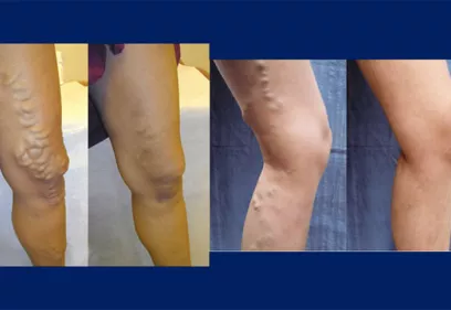 Before and after varicose veins treatment at UCSF Radiology.