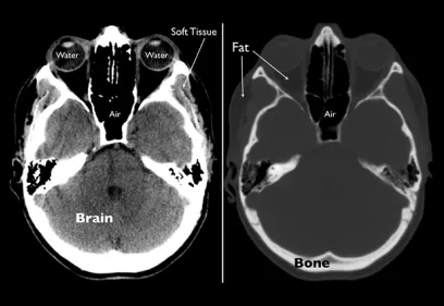 side-by-side axial CT images of the head showing a brain window on the left and a bone window on the right, with labeled areas for soft tissue, water, fat, and air