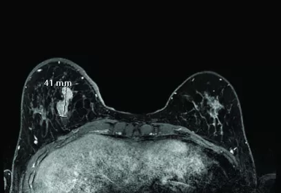 breast MRI scan showing both breasts in axial view with a bright enhancing lesion on the left side marked with a 41 mm measurement indicator, surrounded by fibroglandular tissue against a dark background