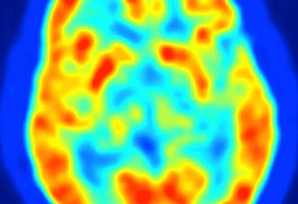 Combine SPECT functional imaging with CT