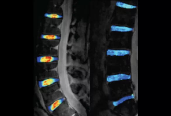 MRI cartilage