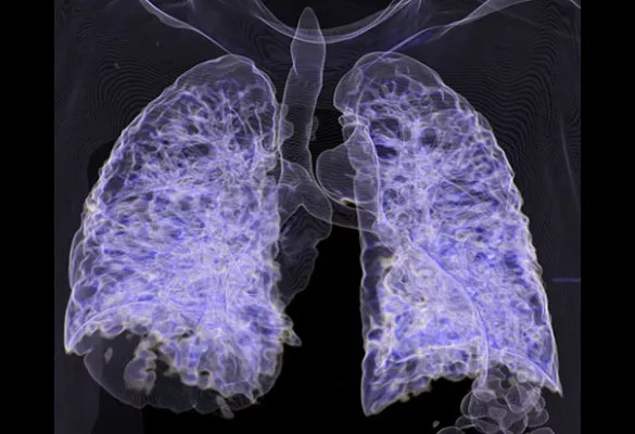 3-D CT lungs