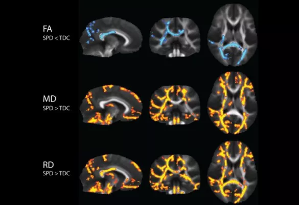 Sensory Processing Disorder