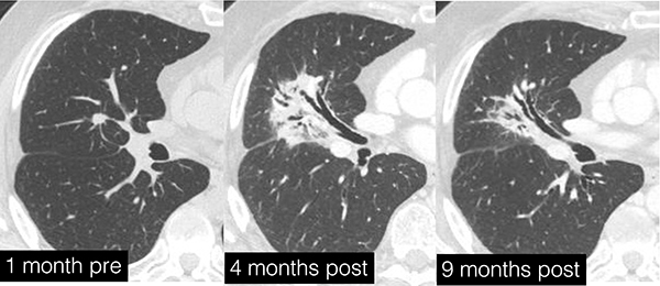 Lung CT scans in spanning 1 month pre, 4 months post, and 9 months post
